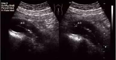 主动脉夹层动脉瘤如何检查和防治,主动脉夹层动脉瘤的超声表现