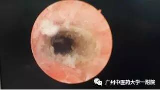 「女科荟」快速去内膜，保留子宫！诺舒，一种治疗月经过多的微创新方法