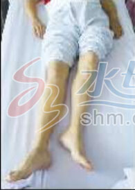 七旬老太摔倒骨盆骨裂,股骨颈骨折百岁老人