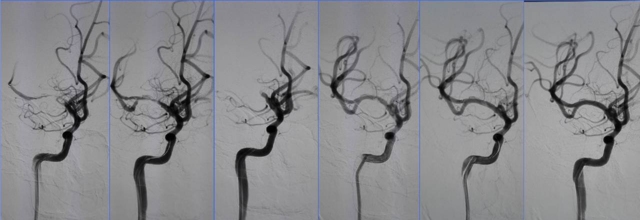 缺血性脑卒中术后管理,急性缺血性脑卒中血管内治疗