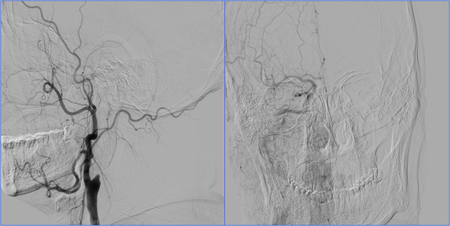 缺血性脑卒中术后管理,急性缺血性脑卒中血管内治疗
