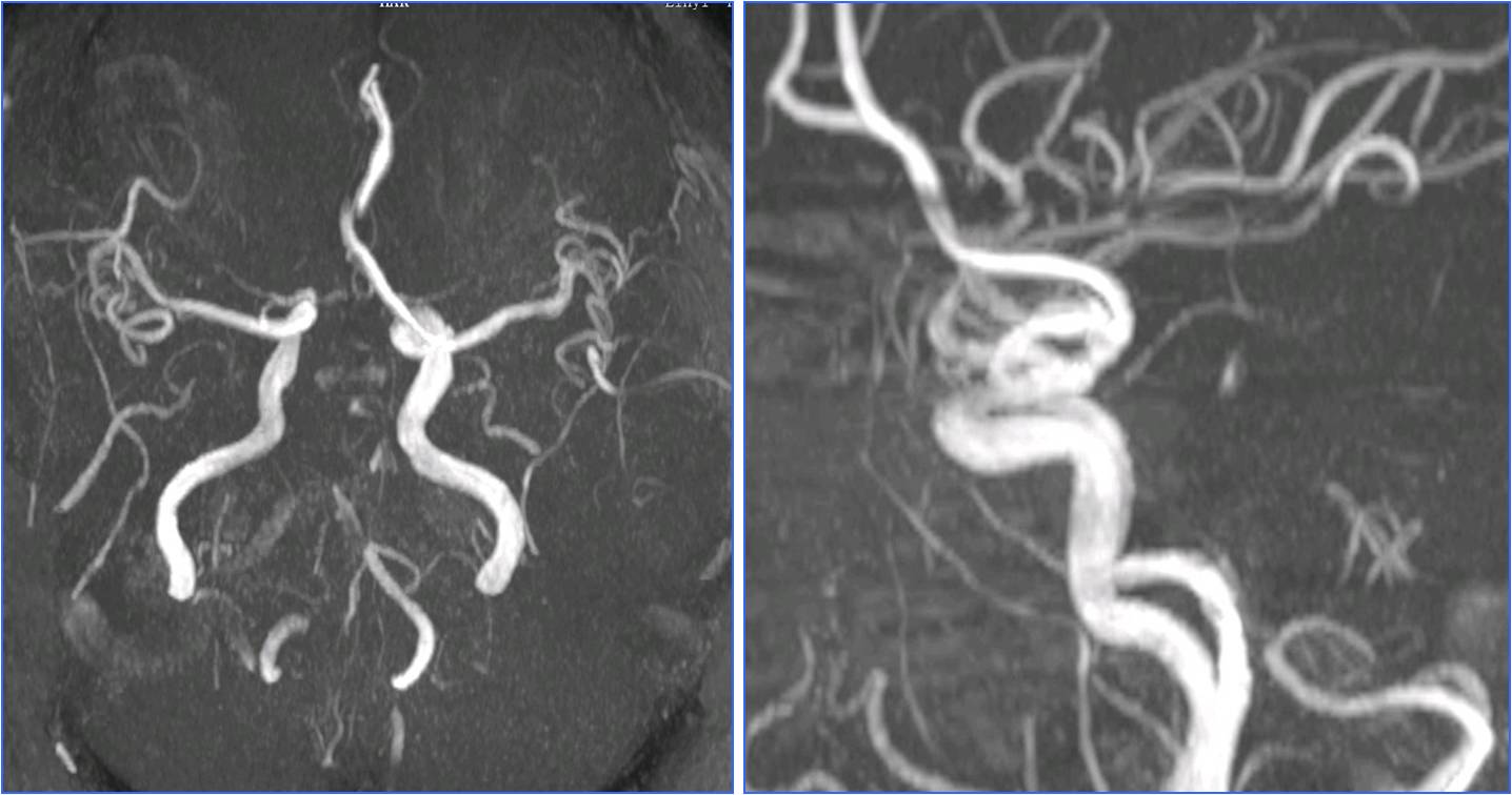 缺血性脑卒中术后管理,急性缺血性脑卒中血管内治疗