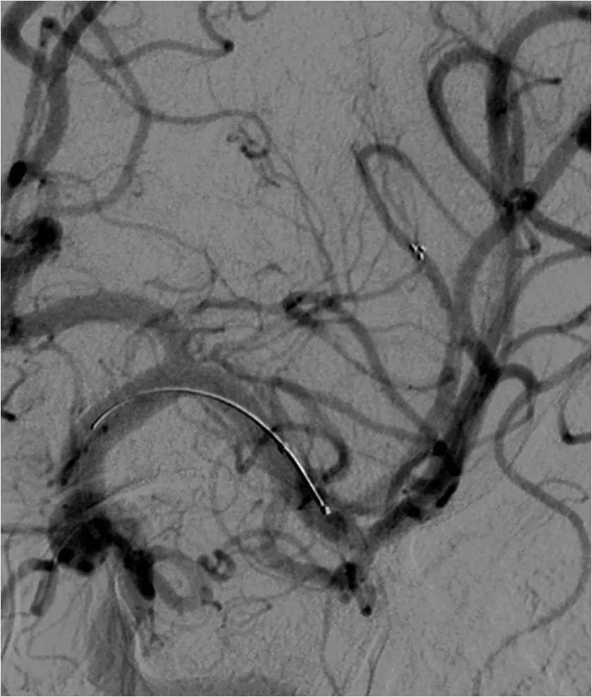 急性缺血性脑卒中血管内治疗,缺血性脑血管病的抗血小板药治疗
