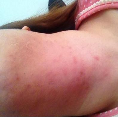 夏季如何防晒保护皮肤,孕妇要怎么护理皮肤