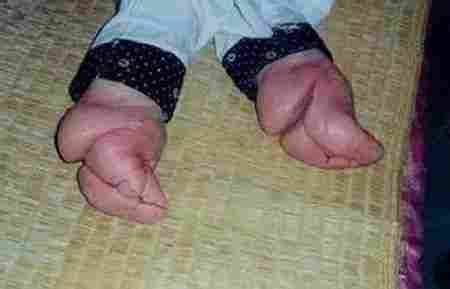 古代病态审美束腰裹脚,古代小脚畸形