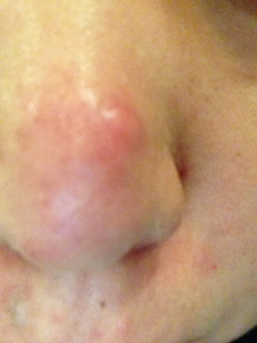 长痘最好的办法就是不要碰它,各种痘对应解决方法