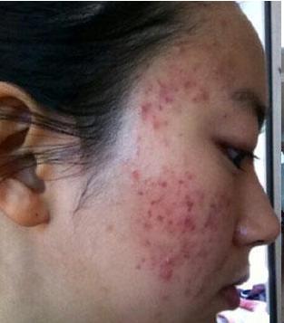 祛痘妙招生理期痘痘治疗方法