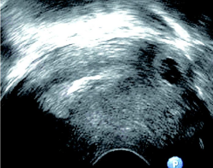 未破裂型输卵管妊娠的超声表现,宫角妊娠与输卵管间质部妊娠区别