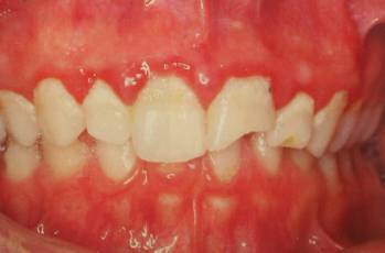 口腔溃疡接吻传染梅毒,接吻会传染口腔癌么