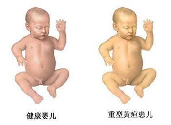 治疗新生儿黄疸最有效的办法,新生儿黄疸怎么造成的