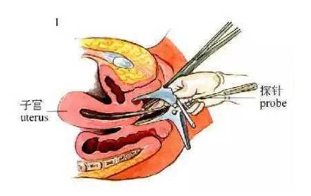 取环详细手术记录,取环术手术步骤