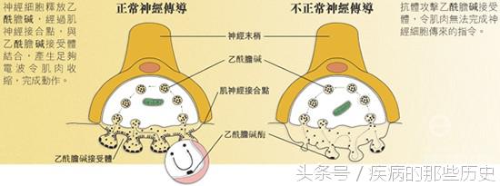 重症肌无力和类重症肌无力,重症肌无力的综述文章