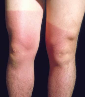 夏季常见皮肤病大片红肿,夏季多发皮肤病