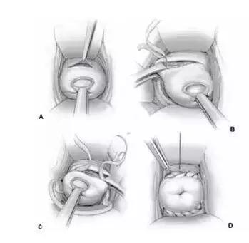 宫颈内口松弛是什么原因引起,宫颈内口松弛行宫颈环扎术时间
