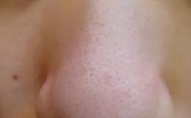 用手挤黑头的方法,用手挤痘痘和黑头