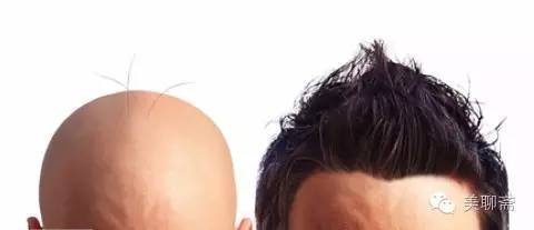 植发亲历,亲身体验植发