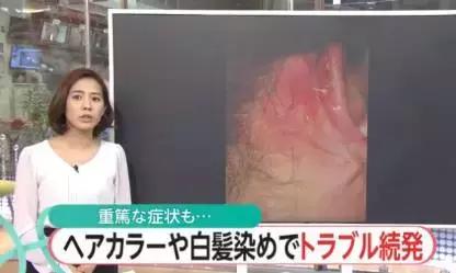 白发补染发根与染全头哪个危害大,染白发发根染黑了怎么处理