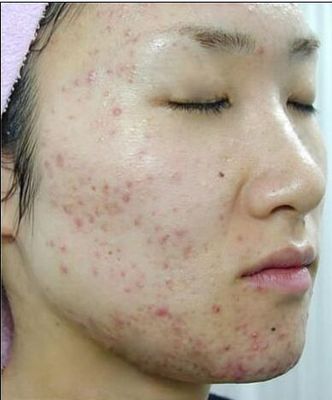 痘痘怎么快速消除医生推荐,痘痘怎么快速消除用什么方法