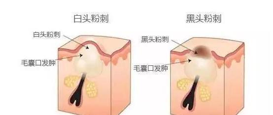 白头粉刺的形成原因及处理方法,什么是粉刺闭合性粉刺图片