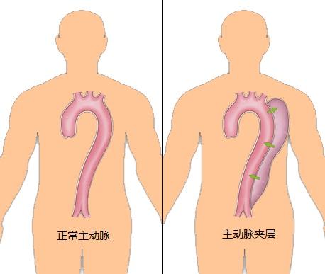 美国治疗主动脉夹层,倪海厦治疗主动脉夹层