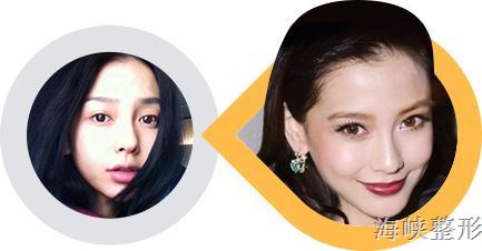 玻尿酸丰唇后恢复原样图片,玻尿酸丰鼻会变宽的对比照