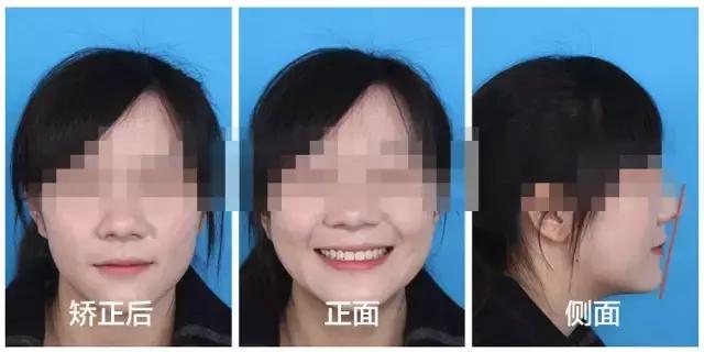 牙齿矫正是拔牙多好还是少好,为什么牙齿矫正一般都要拔牙