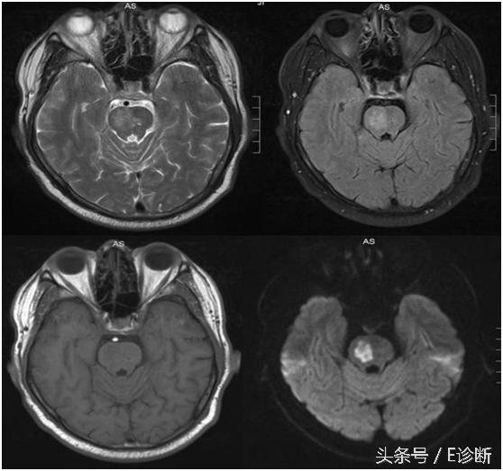 E诊断：脑梗塞影像图解