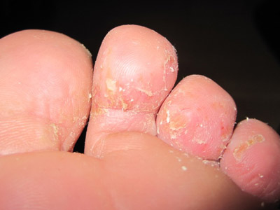 治疗孕妇脚气的9个小偏方大全,倪海厦治疗脚气除根的小偏方