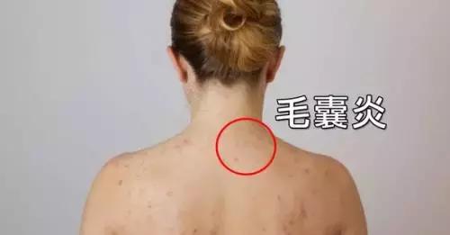 夏天是“毛囊炎”发作高峰期！5种自救法摆脱红肿胀痛