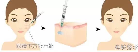 玻尿酸丰唇后恢复原样图片,玻尿酸丰鼻会变宽的对比照