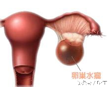 卵巢生了这肿瘤，一定要看清，别后悔而治错了！