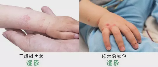 出痱子怎么办成人,痱子的原因及相对应的护理方法