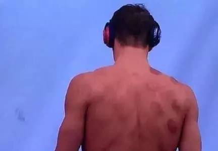 拔火罐有真空原理吗,拔火罐的来源