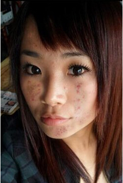 祛痘淡化痘印男女皆可,祛痘不留疤痕最有效方法