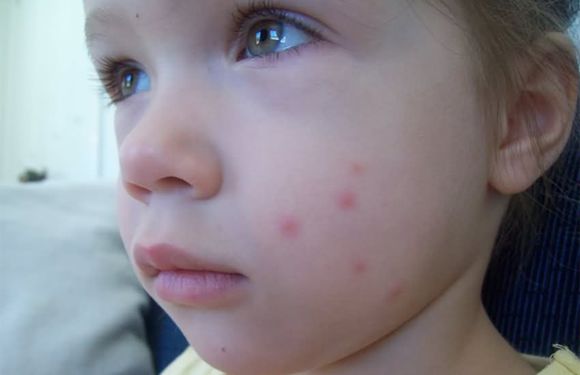 紫草膏可以治热痱子吗,痱子用紫草膏