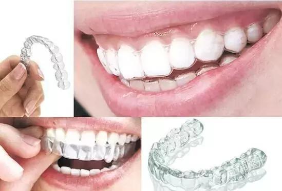 隐形正畸矫正术前拍片,牙医helen工作室