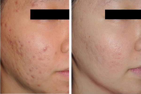 去痘痘痘疤最好的方法,痘痘好不了一直结痂