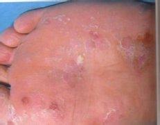 孕妇有脚气能用唯达宁吗,孕妇脚气怎么办应该用什么