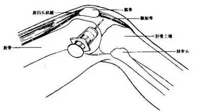 倪海厦治疗膝关节积液,膝关节积液可以热敷吗