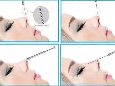 埋线鼻子vs假体隆鼻,隆鼻假体和埋线隆鼻