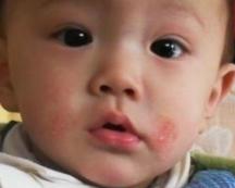 婴儿皮肤湿疹如何治疗,儿童湿疹溃烂怎么办