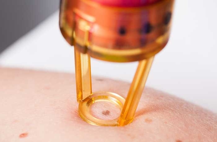 孙红雷谈黑痣长在哪里,孙红雷演的黑痣病变