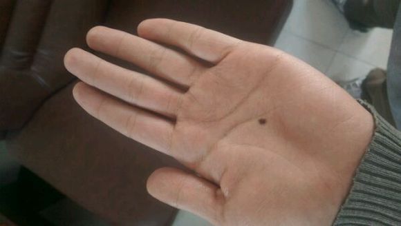 孙红雷谈黑痣长在哪里,孙红雷演的黑痣病变