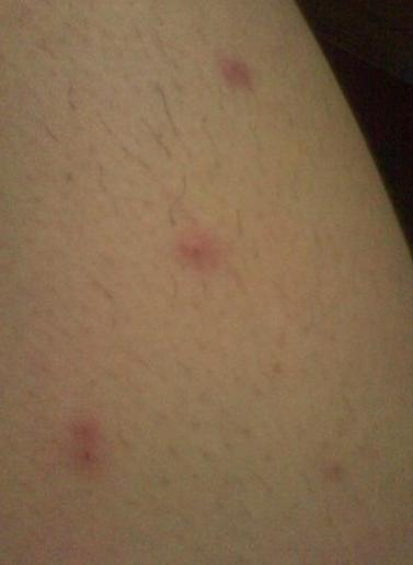 水泡湿疹怎么治疗?老中医妙招治皮肤病湿疹。