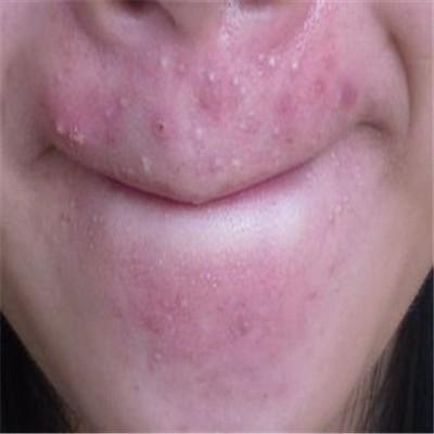 *疮痤**怎么治疗小窍门有哪些