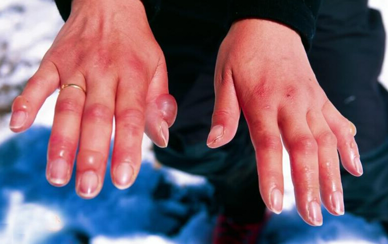 冻伤防治知识宣讲,知识椰奶冻