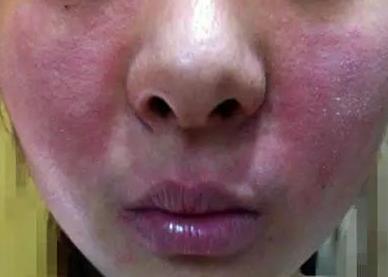 激素脸毛孔特别粗大怎么治疗,激素脸总是干燥起皮很痒怎么修复