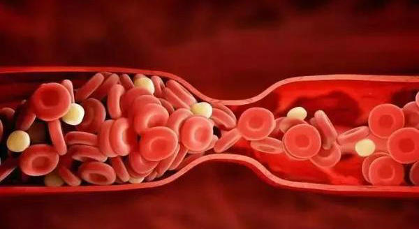 picc静脉血栓相关知识,picc相关性静脉血栓诊断标准