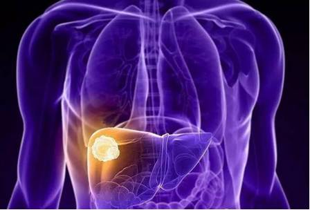 肝癌晚期食疗法,中医对晚期肝癌有何调养处方