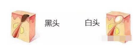 毛孔粗大黑头痘痘适合哪种护肤品,毛孔粗大黑头痘痘修复烂脸精华液